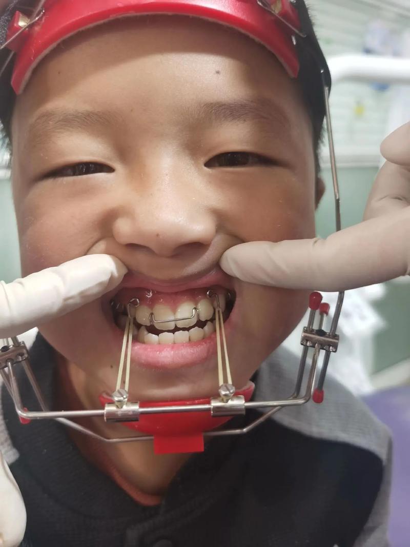 银川地包天矫正效果如何？能改善脸型吗？-图1