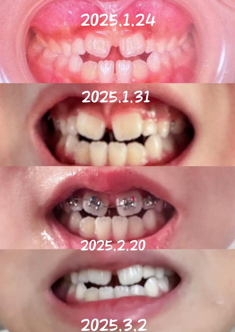 银川地包天矫正效果如何？能改善脸型吗？-图2