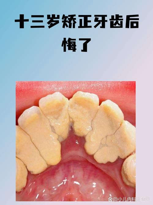 为什么手术矫正牙齿会后悔？后遗症真这么难熬？-图2