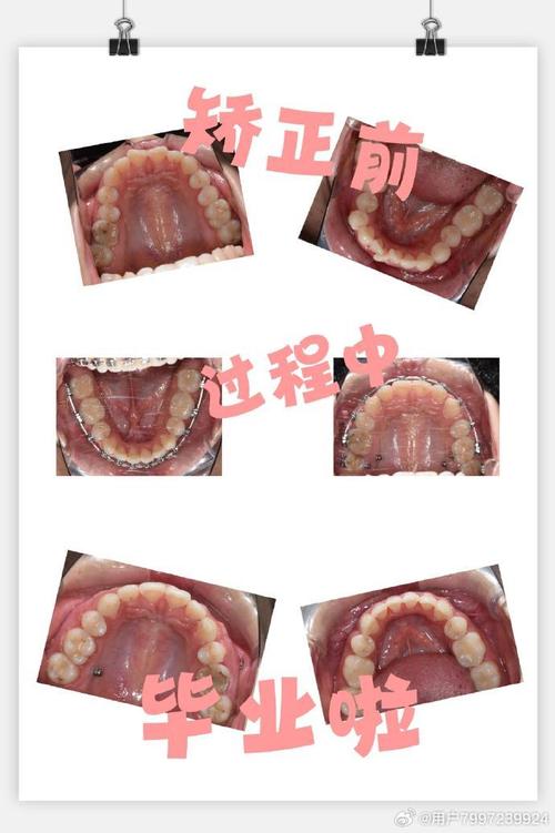 孕期整牙矫正可行吗？对胎儿有影响吗？-图3