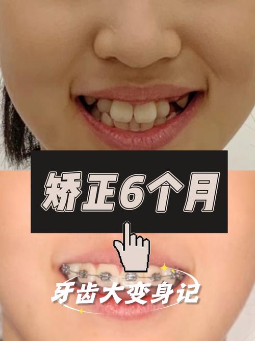 小孩牙齿矫正的最佳年龄是几岁?-图1 小孩牙齿矫正的最佳年龄是几岁?-图1