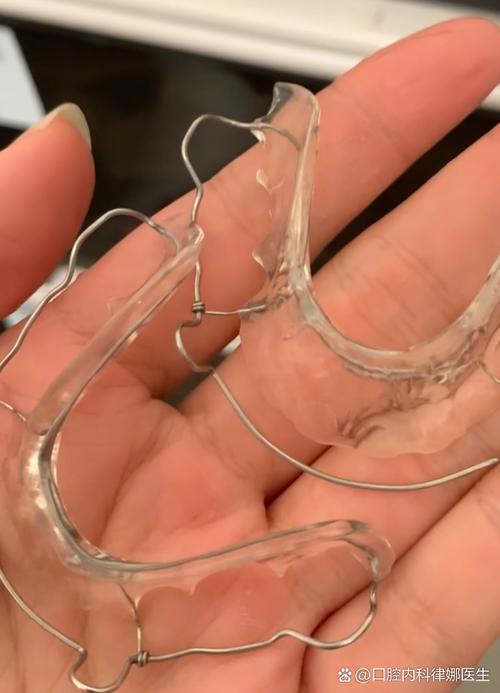 牙齿矫正门牙松动，是正常现象还是需警惕的问题？-图1