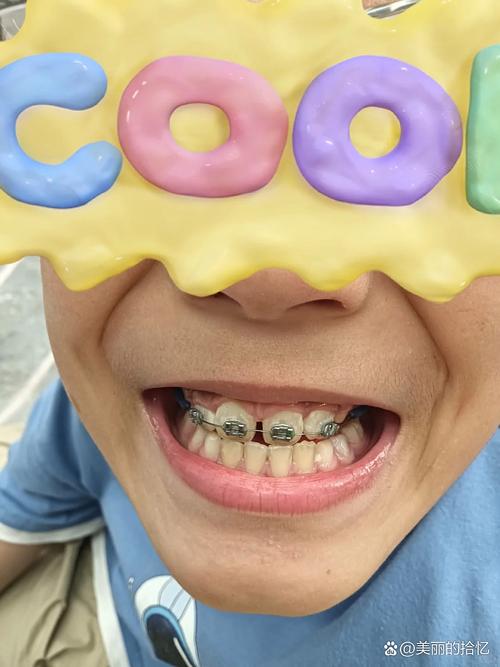 牙齿矫正门牙松动，是正常现象还是需警惕的问题？-图2