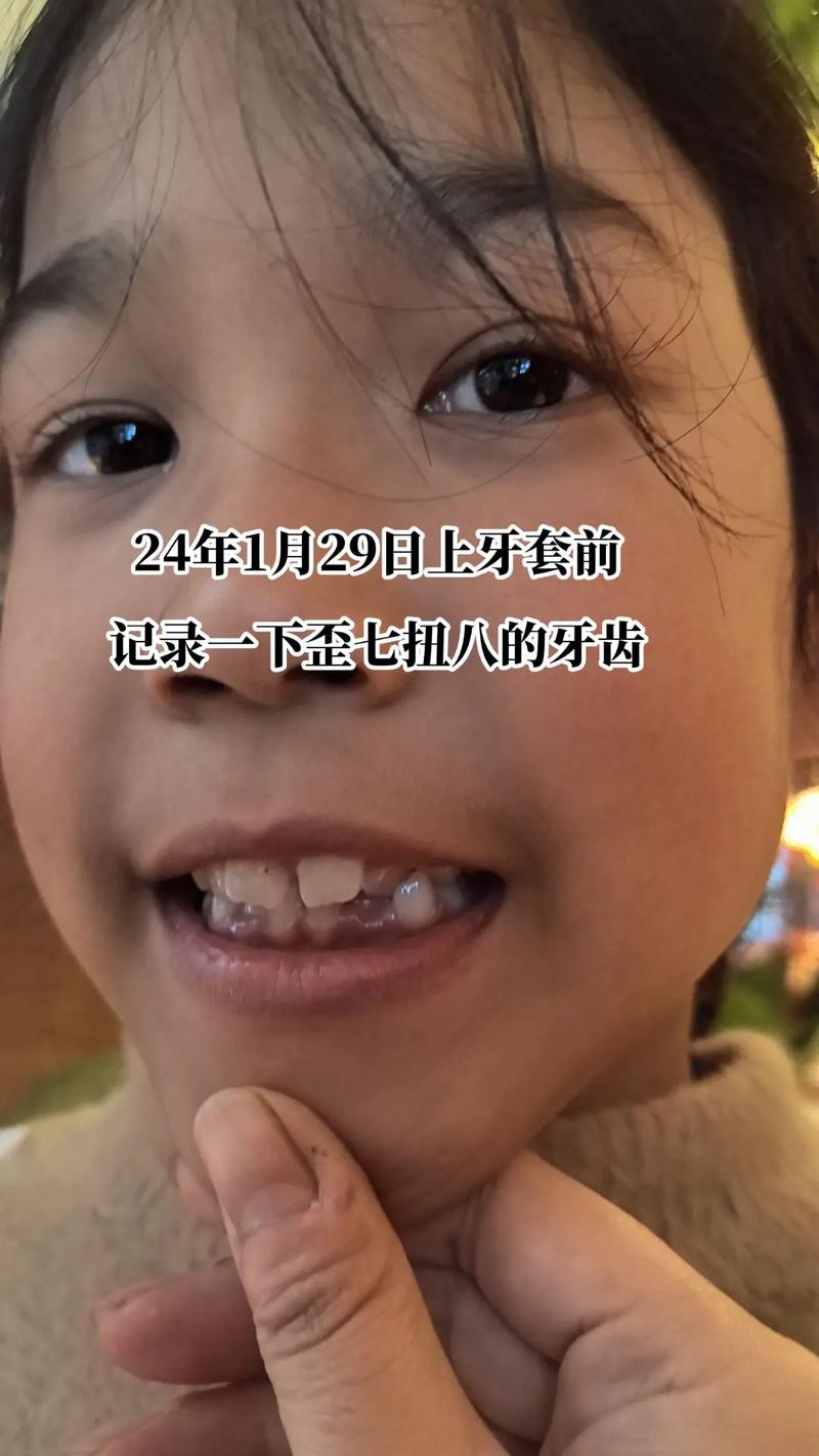 牙齿矫正门牙松动，是正常现象还是需警惕的问题？-图3