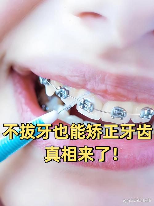 矫正牙齿不拔牙，反弹原因是什么？-图2