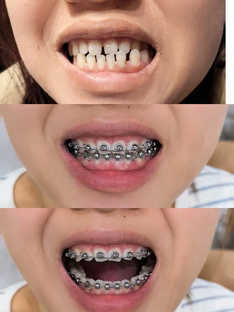 成年矫正牙齿后反弹，原因何在？如何预防与应对？-图3