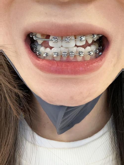 矫正后牙缝很大，是什么原因？该怎么解决？-图2