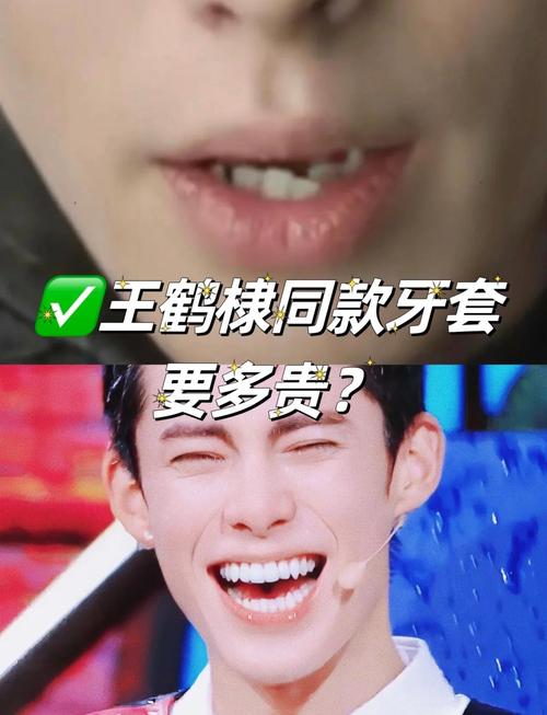 明星如何悄悄矫正牙齿？藏着哪些高效又隐蔽的方法？-图1