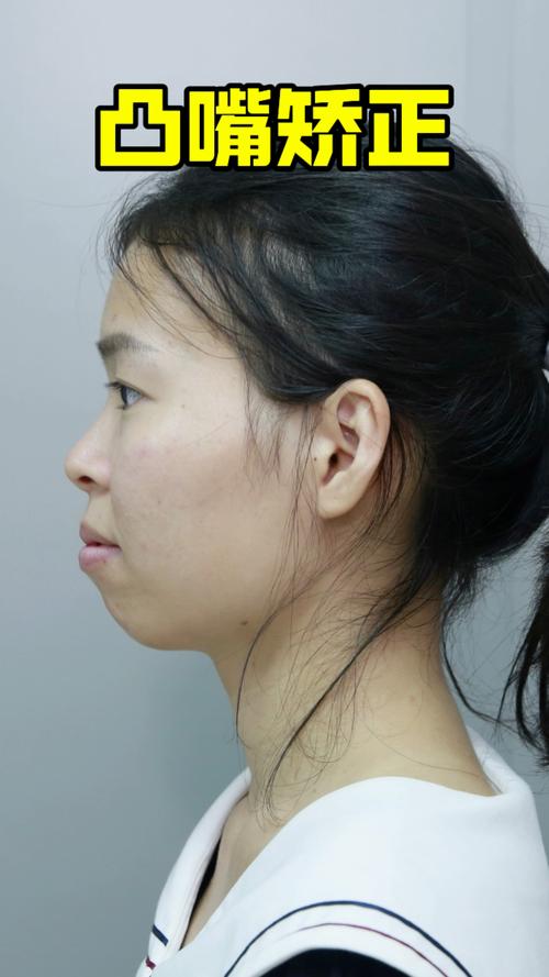 矫正牙齿后嘴巴突出，是矫正效果问题吗？原因是什么？-图1