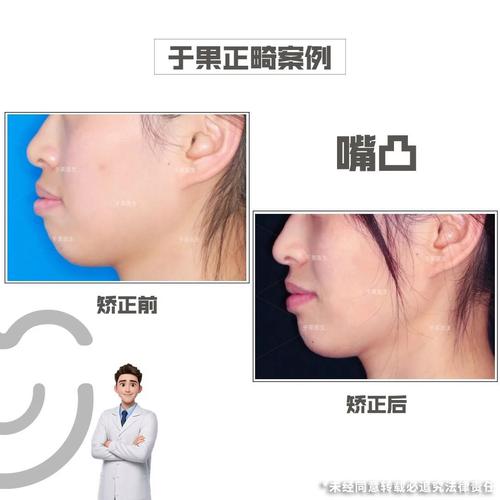 矫正牙齿后嘴巴突出，是矫正效果问题吗？原因是什么？-图3