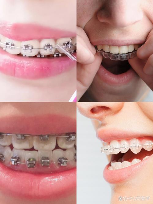 快速矫正牙齿真的可行吗？大概多久能见效？-图2