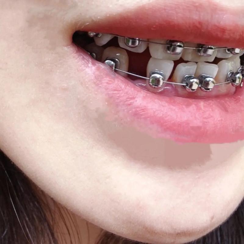 矫正牙齿加力时痛得厉害，这是正常现象吗？-图1