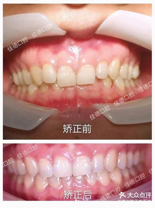 合肥哪家矫正牙齿好-图2