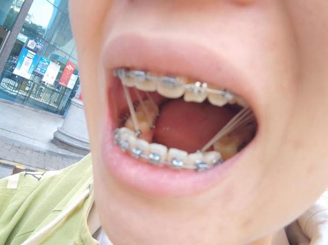 27岁矫正牙齿晚不晚？成年人矫正效果会受年龄影响吗？-图3