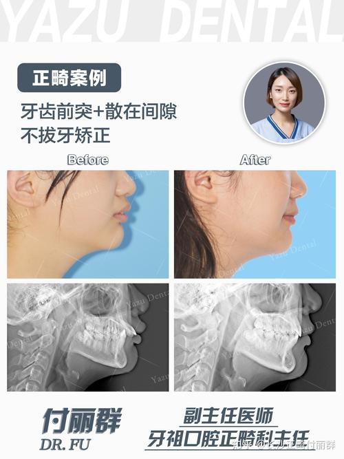 拔牙矫正收缝隙,过程要多久?怎么收才有效?-图2 拔牙矫正收缝隙,过程要多久?怎么收才有效?-图2