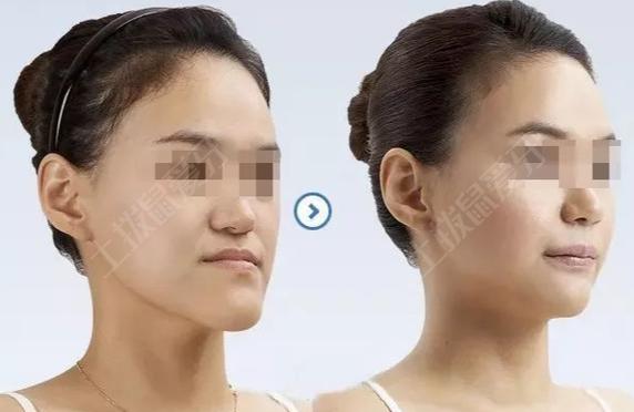 牙齿矫正会改变鼻子-图3