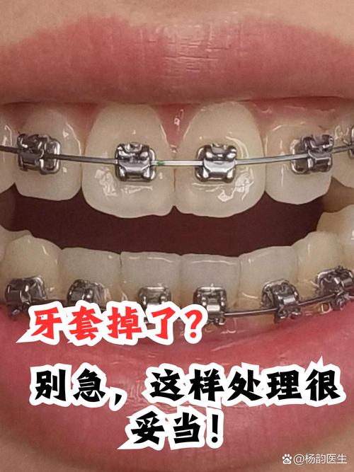 牙齿矫正托槽老是掉？原因和解决方法详解-图3