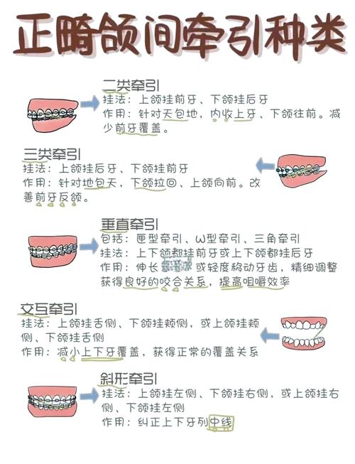 牙齿稀疏矫正的原理是什么？如何实现牙齿的重新排列与整齐？-图2