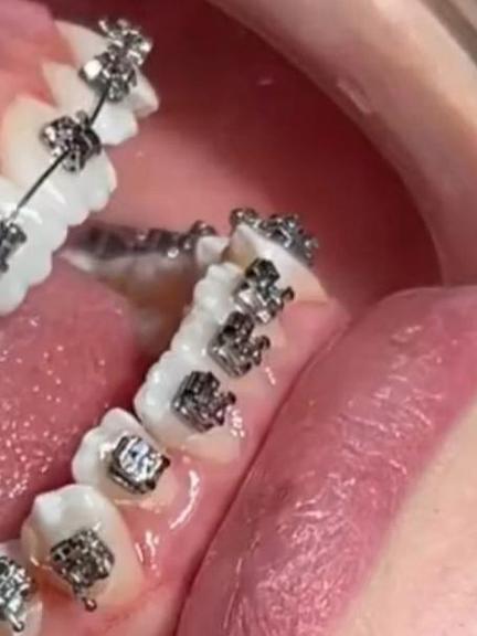 矫正牙齿的钢丝误食了会有什么后果？-图2