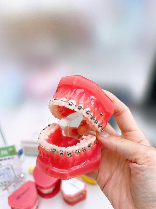 仿生美容冠矫正牙齿的效果能像真牙一样自然持久吗？-图2