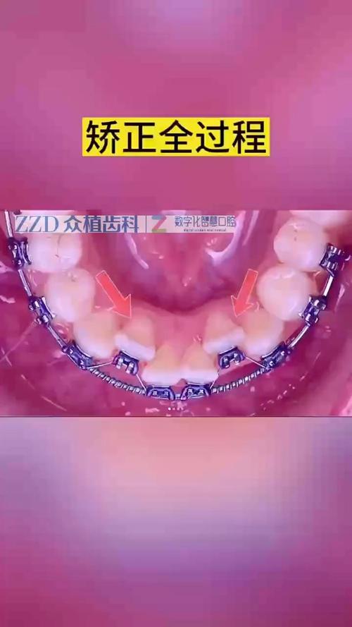 广州矫正牙齿的步骤-图2