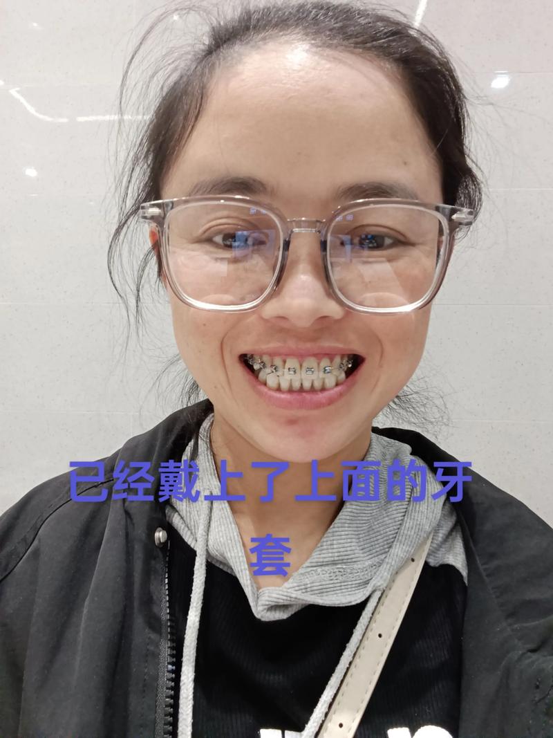 牙齿矫正 口腔溃疡-图1