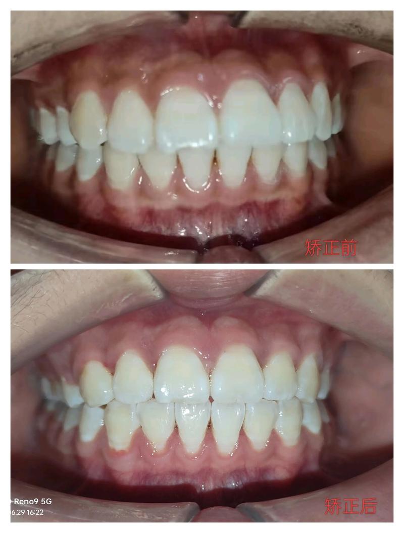 矫正牙齿前后的图片-图2