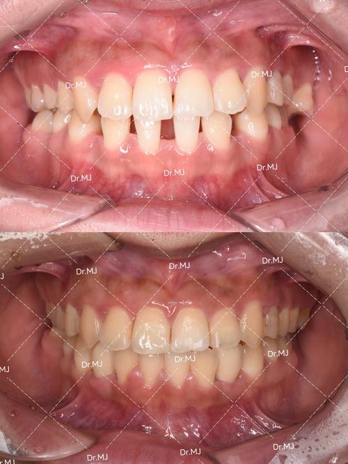 矫正牙齿前后的图片-图3