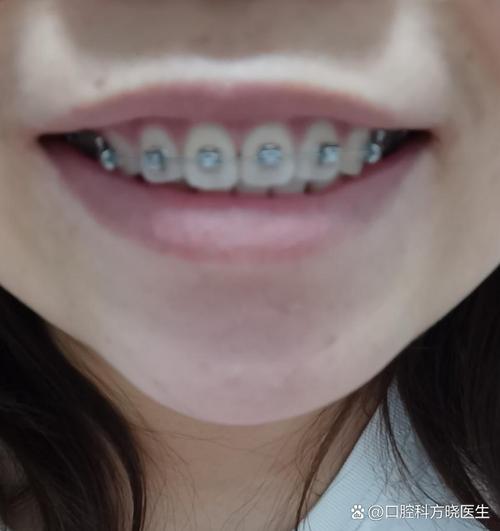 牙齿矫正后为何还有缝隙？会慢慢消失吗？-图3