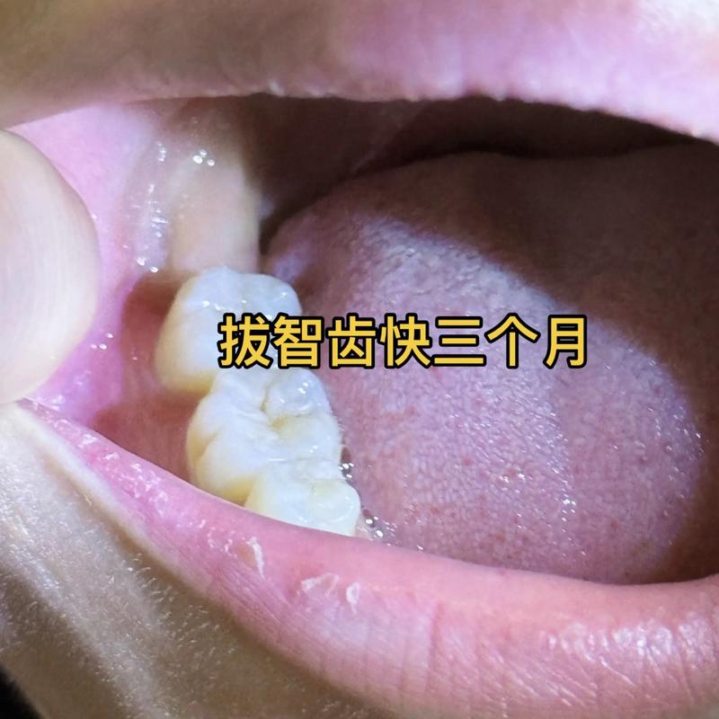 拔智齿矫正牙齿效果究竟如何？矫正效果会更好吗？-图2