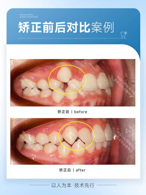 成年了矫正牙齿好吗-图2