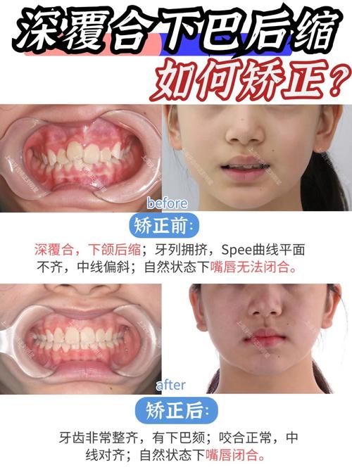 矫正牙齿为什么会导致下颌响？-图1