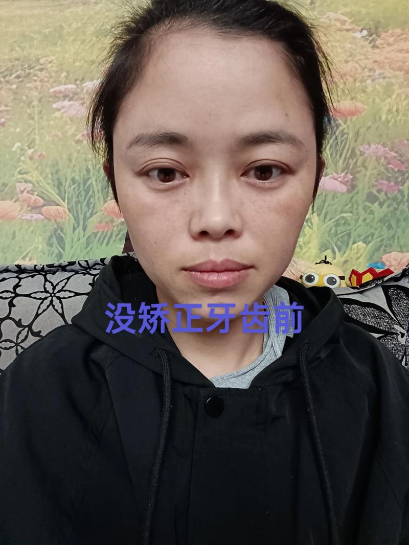 牙齿矫正后露牙龈加重，是矫正方式问题吗？-图1