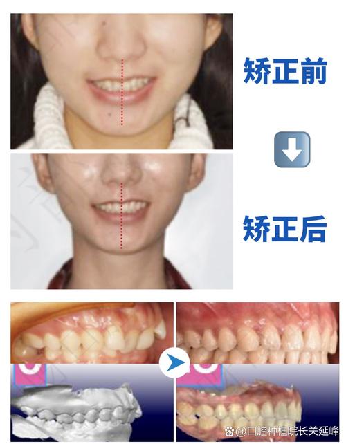 牙齿矫正后露牙龈加重，是矫正方式问题吗？-图2