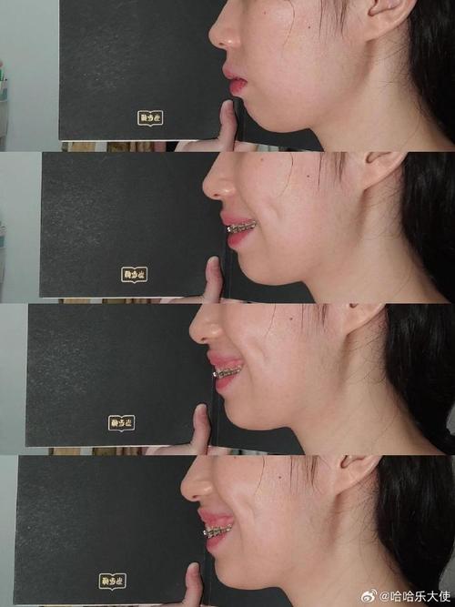 牙齿矫正牙龈外露是什么原因？-图1