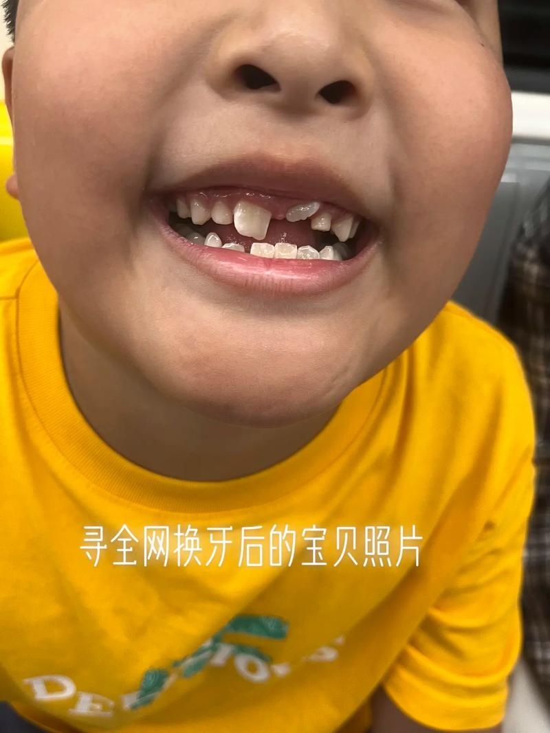 矫正牙齿真的会让牙齿掉落吗？有没有这种情况？-图2