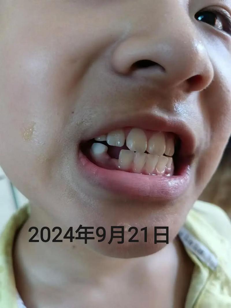 矫正牙齿真的会让牙齿掉落吗？有没有这种情况？-图3