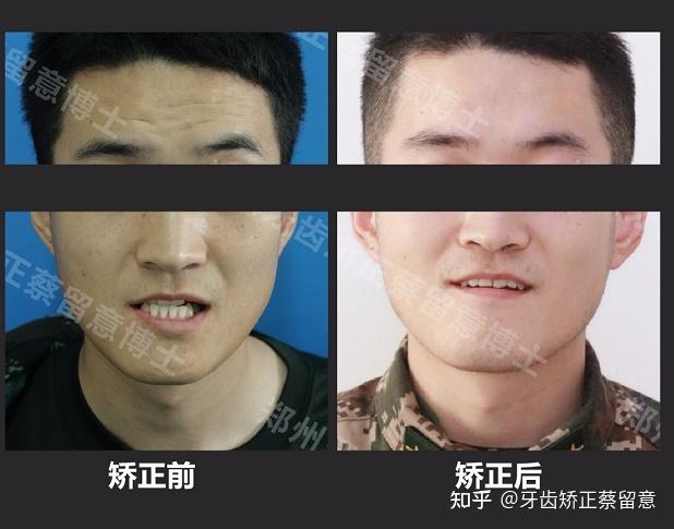 郑州矫正牙齿哪家好？专业机构怎么选？-图2