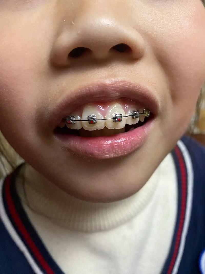 儿童牙齿矫正疼不疼？家长必知的疑问解答-图3