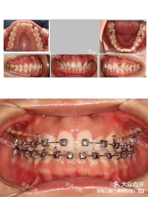 矫正牙齿后不戴保持器，牙齿会反弹吗？-图2
