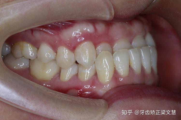 隐形矫正牙齿地包天-图2