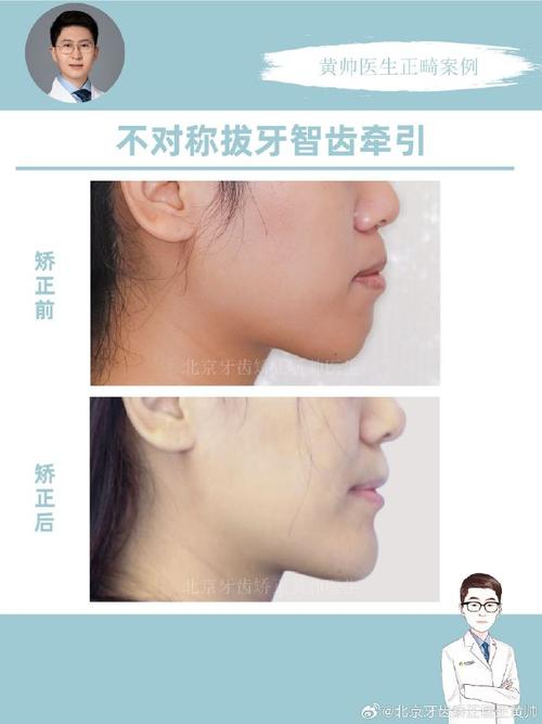 北京牙齿矫正哪家好？求推荐靠谱机构，想看真实案例反馈！-图3