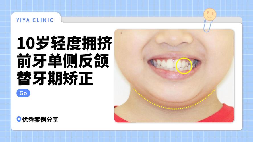 拔牙后不想矫正，牙齿和健康会受影响吗？-图3