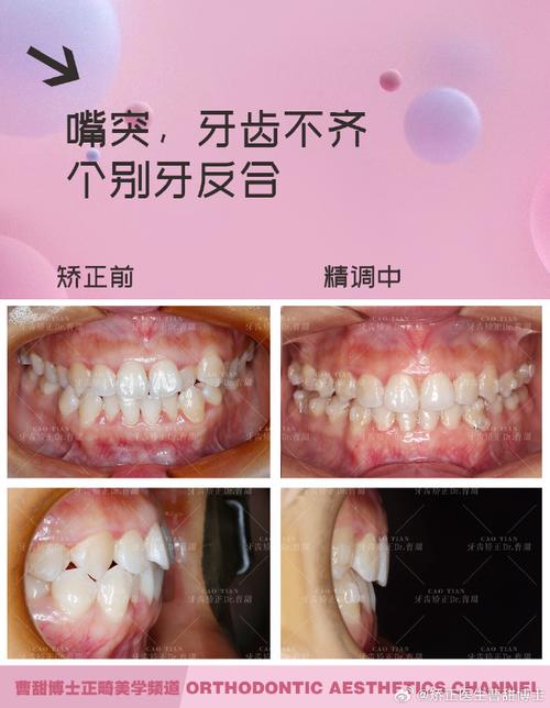 颧骨高矫正牙齿会影响脸型或效果吗？-图3