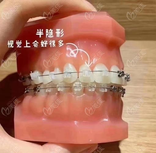 昆山哪家牙齿矫正好-图2