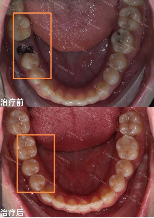 矫正牙齿时不想拔智齿，可行吗？会对矫正效果有什么影响？-图3