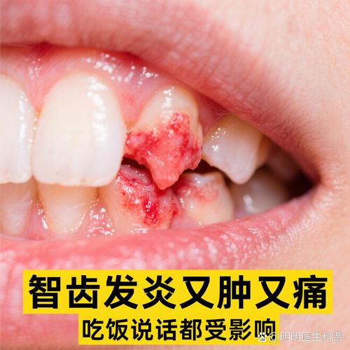 矫正牙齿期间牙龈发炎，是什么原因导致的？该如何正确护理和处理？-图3