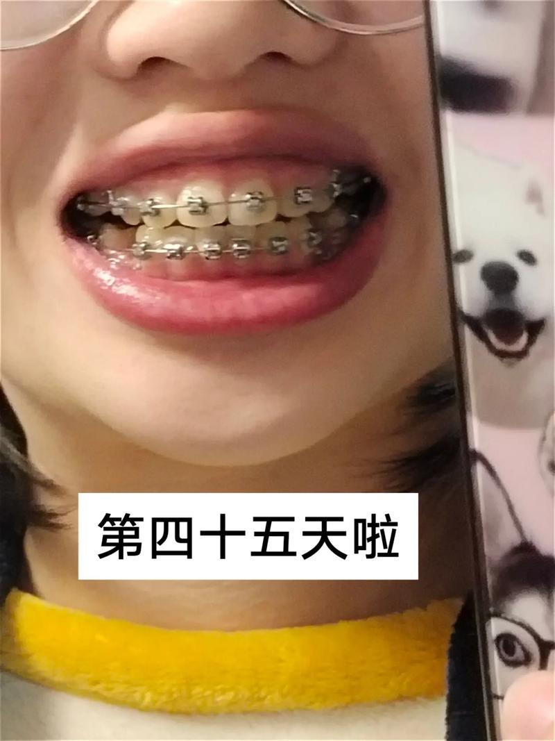 矫正牙齿后出现大牙缝，是矫正不当还是正常现象？-图2