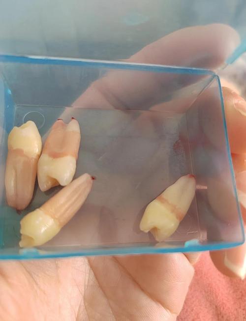 矫正牙齿为何要拔一颗？拔牙的必要性是什么？-图3