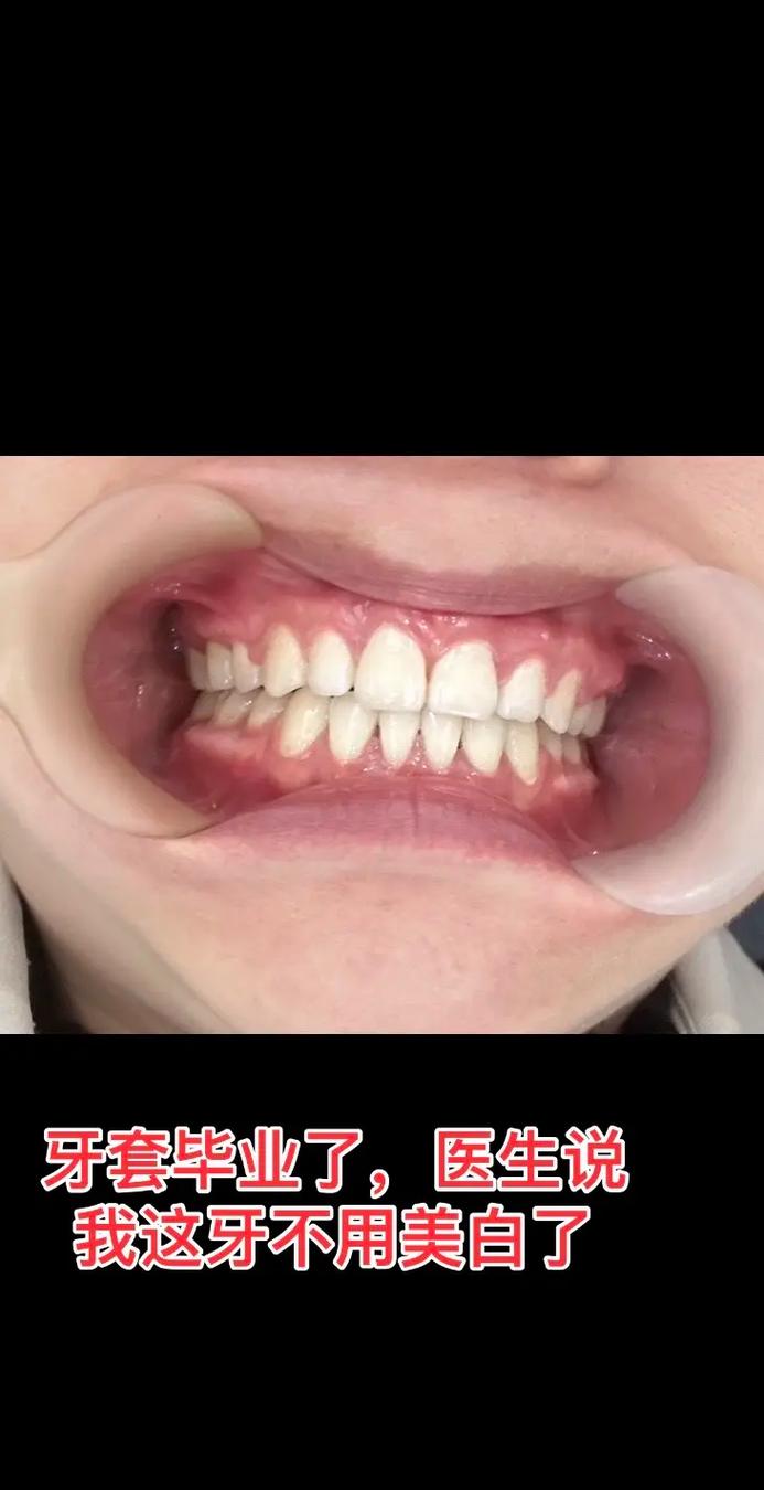 牙龈萎缩矫正牙齿会加重病情吗？-图2